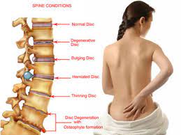 What are symptoms of Spine Problems